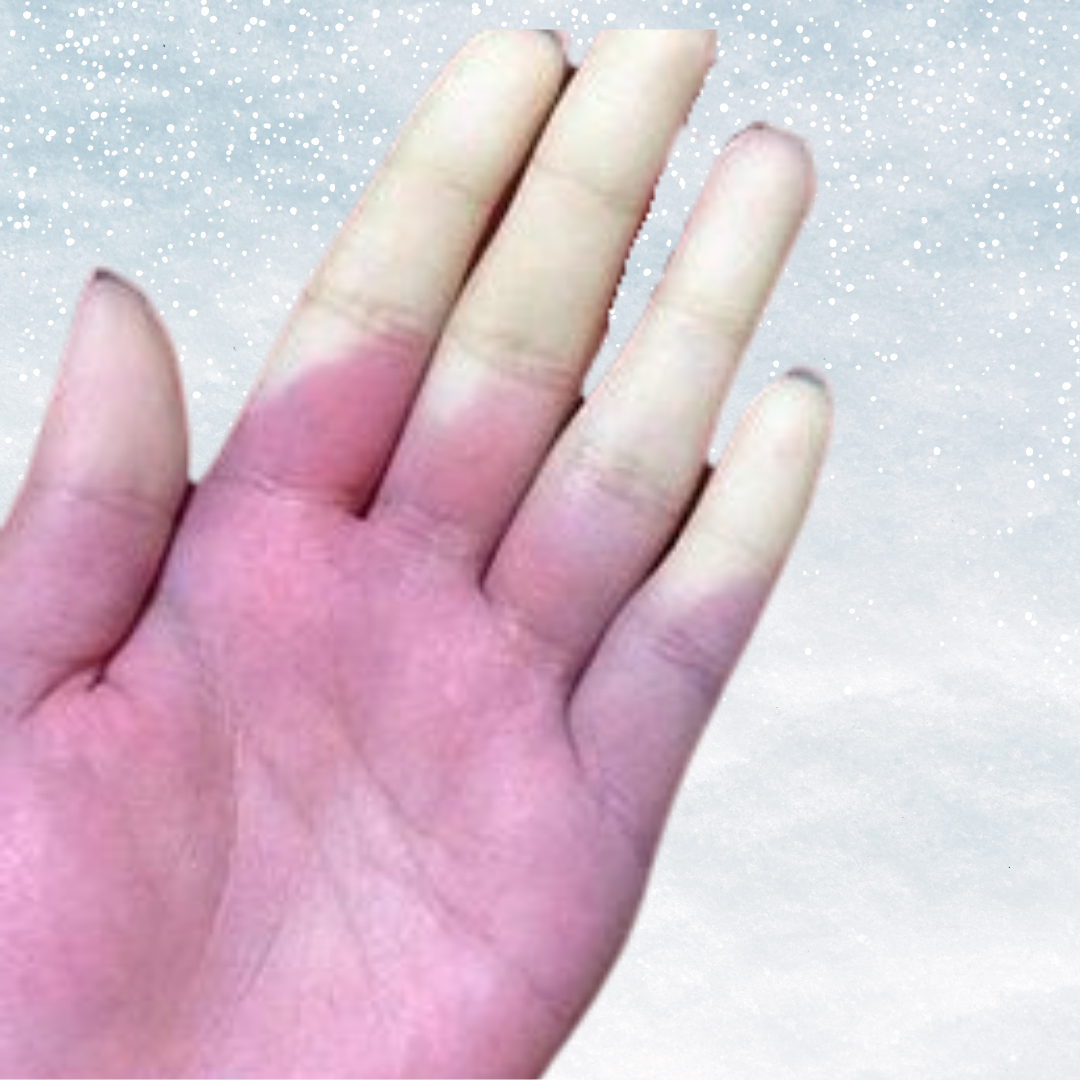 stayingwarmwithraynauds