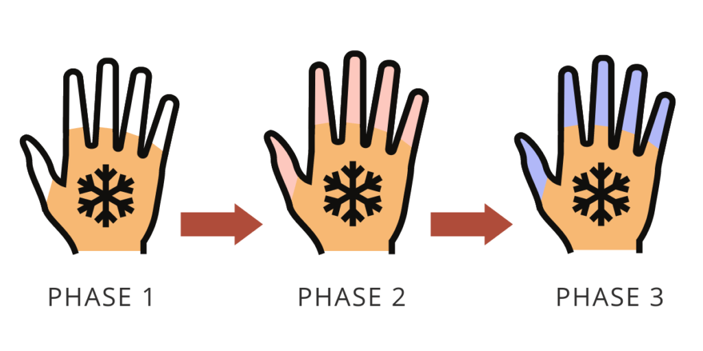 stages of Raynaud's phenomenon