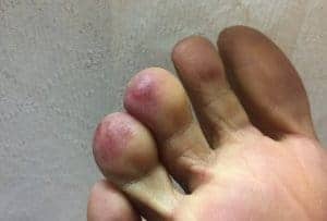chilibans on toes from Raynaud's