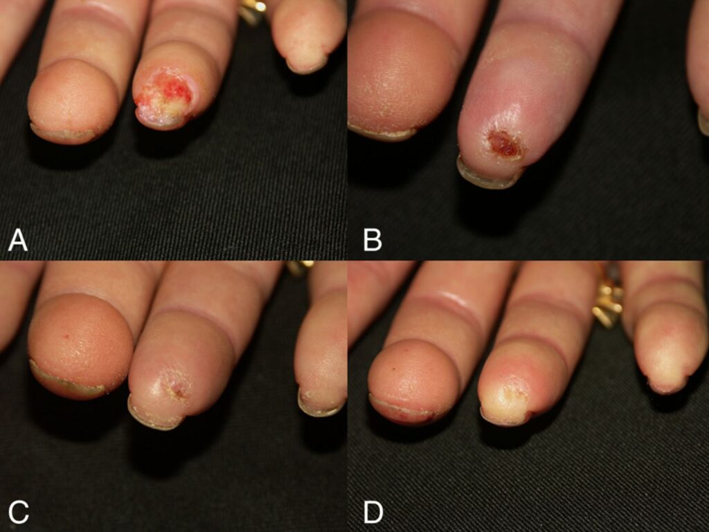 Skin ulcers from raynaud's disease
