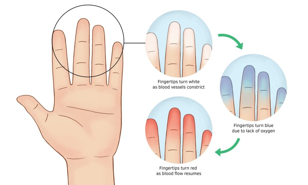 Raynaud's color changes in hands